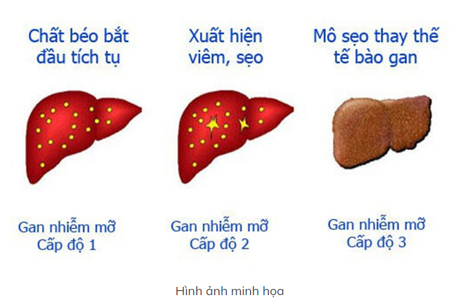 Dấu Hiệu Nhận Biết Gan Nhiễm Độc
